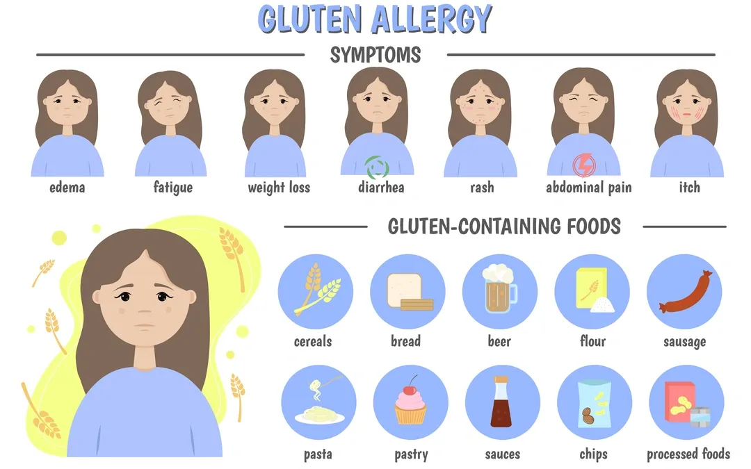 Illustration showing gluten allergy symptoms like edema, fatigue, and rash, and gluten-containing foods such as bread, pasta, and beer.